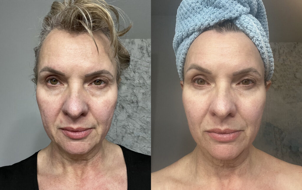 Petal and Sky Esthetics Belmont, NC Before and After 2